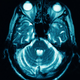 Image for article titled This Neural Implant Knows When Your Next Seizure Will Strike
